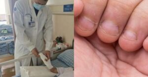 Thường xuyên cắn móng tay, bé 9 tuổi nhập viện phẫu thuật ba lần mới qua khỏi, mẹ ray rứt vì ngỡ bình thường