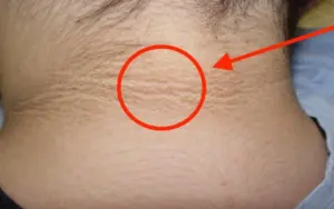 Dấu hiệu “lạ” trên cổ cảnh báo căn bệnh đáng sợ cha mẹ nên để ý ở con