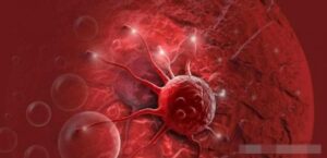 Những người có khối u á.c tính trong cơ thể thường biểu hiện 5 dấu hiệu; hãy chú ý kỹ trước khi quá muộn