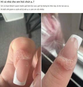 Một người bị nổi ‘u nhú’ do nhiễm HPV sau khi làm nail khiến chị em xôn xao
