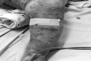 Nóng: Ghi nhận 1 ca tử vong do viêm não mô cầu, bé gái 11 tuổi ra đi chỉ sau một ngày phát bệnh