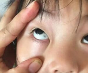 Phát hiện đốm đen trong tròng mắt con, gia đình hoang mang nhanh chóng cho bé nhập viện và cái kết không ngờ