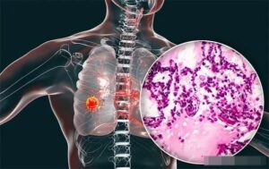 Ngày càng nhiều người mắc UT phổi! Bác sĩ cảnh báo: 4 loại thực phẩm tuyệt đối không ăn khi để trong tủ lạnh quá lâu