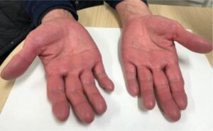 Việt Nam nằm trong nhóm có tỷ lệ tử vong cao vì ung thư gan, đừng bỏ qua “2 hôi, 2 ngứa, 2 đỏ” mà cơ thể đang cầu cứu