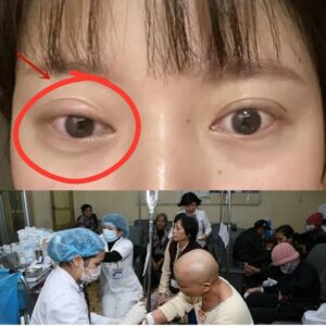 Nếu mắt bạn có 6 dấu hiệu này thì hãy đi khám ung thư khẩn cấp